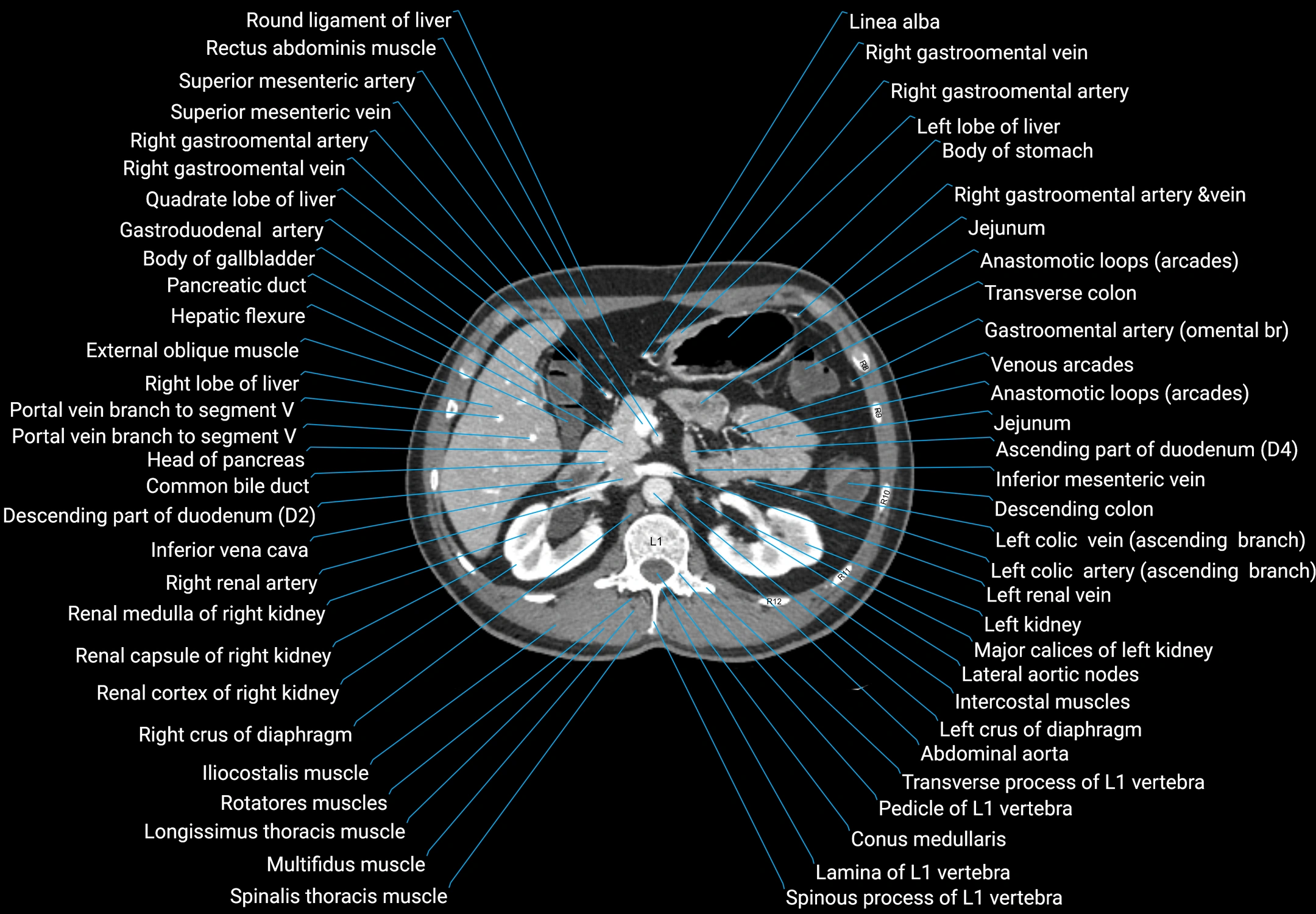 CT male pelvis axial cross sectional anatomy labelled radiology image -00058.webp